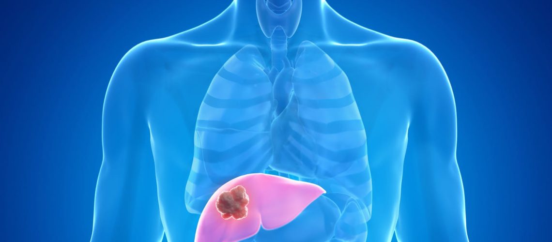 Tout savoir sur l'angiome hépatique : causes, symptômes et traitements